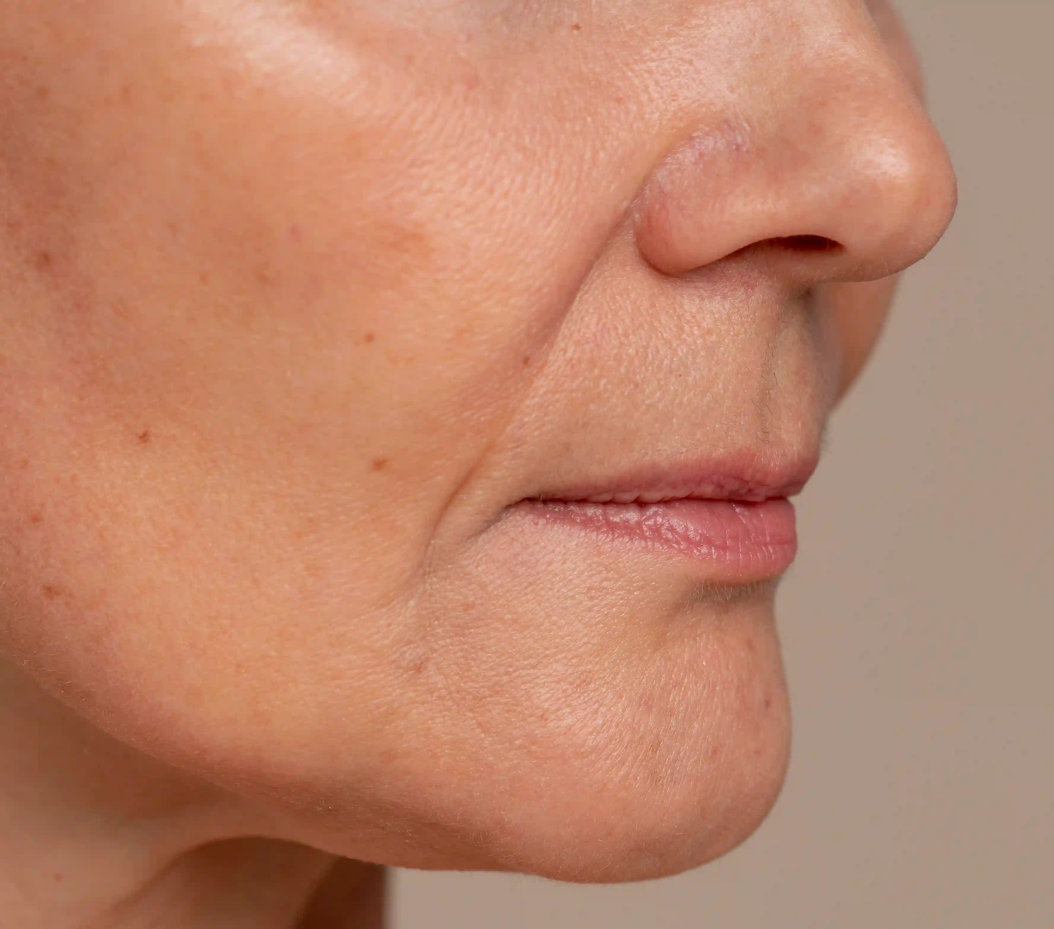 Close da região malar.